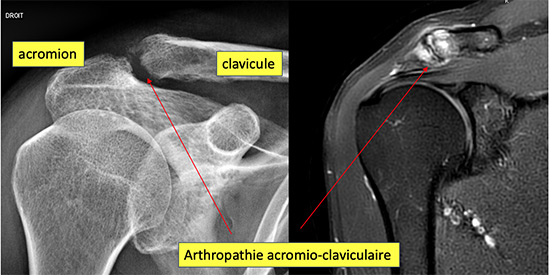 Acromio-claviculaire