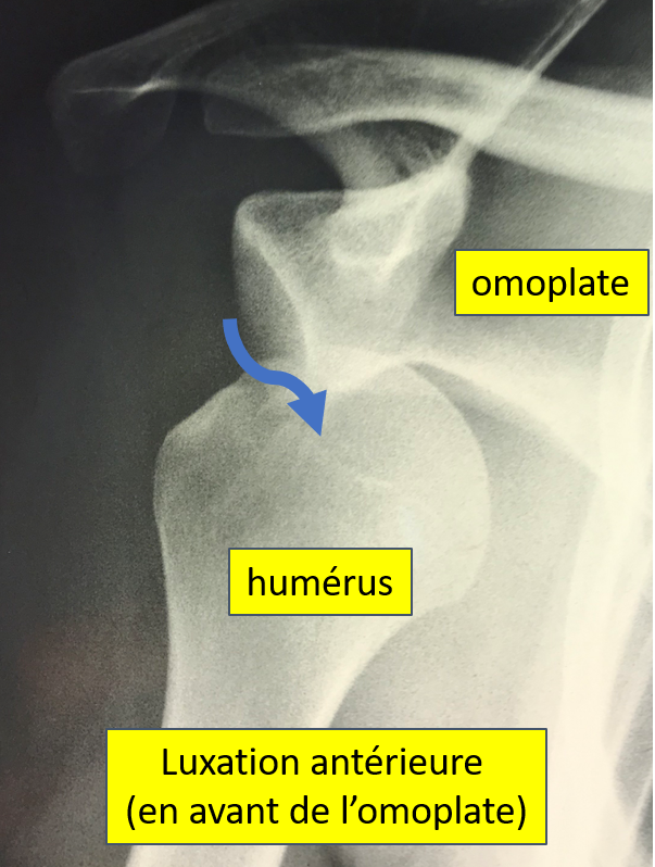 instabilite epaule anterieure